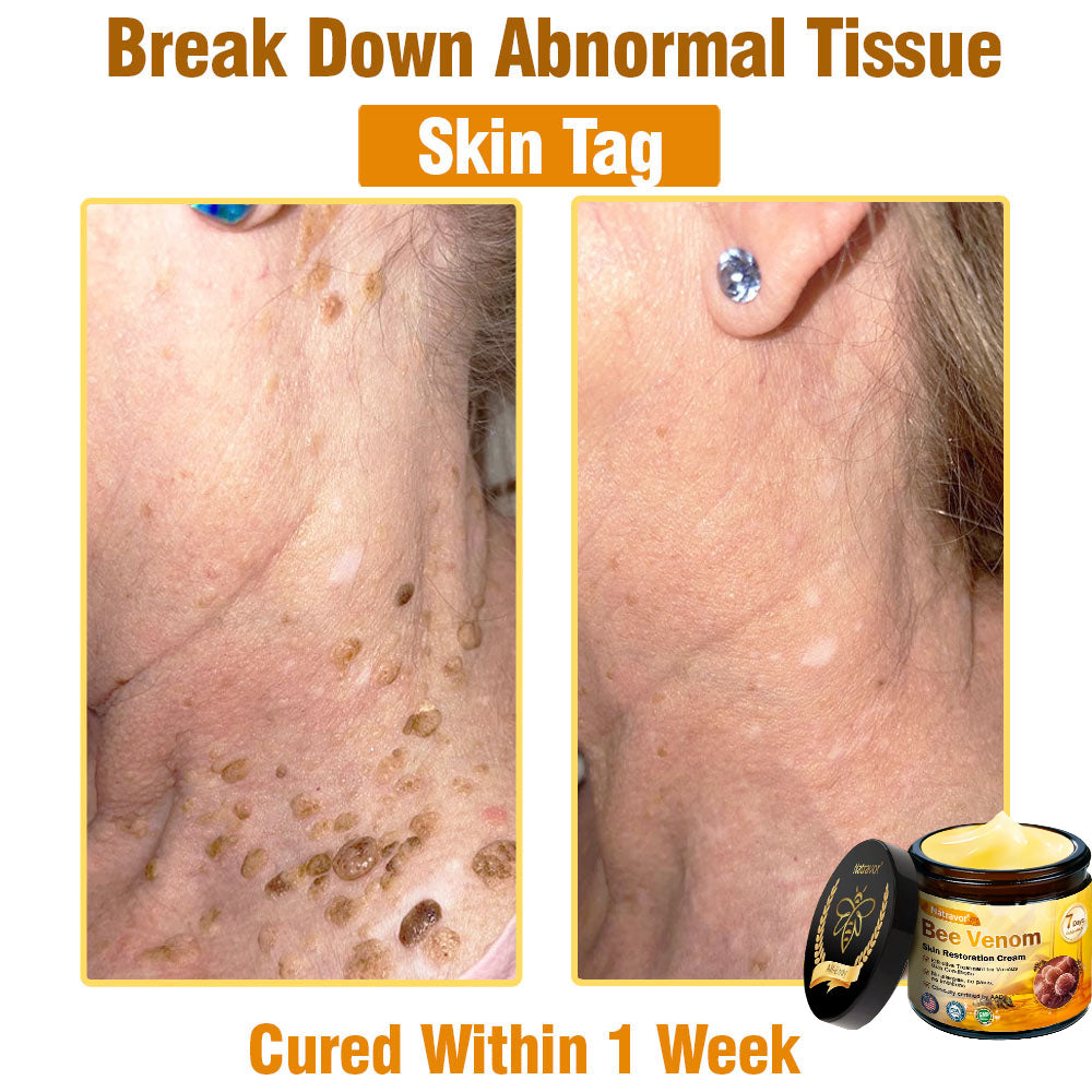 Dermatology Official: Natravor® Skin Treatment Cream Anti-aging, Hydrating, Skin Repair, Even Tone, Acne and Dark Spot Treatment, Wart and Mole Removal, Psoriasis Relief