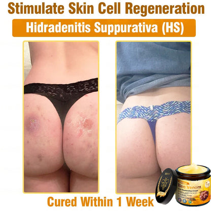 Dermatology Official: Natravor® Skin Treatment Cream Anti-aging, Hydrating, Skin Repair, Even Tone, Acne and Dark Spot Treatment, Wart and Mole Removal, Psoriasis Relief