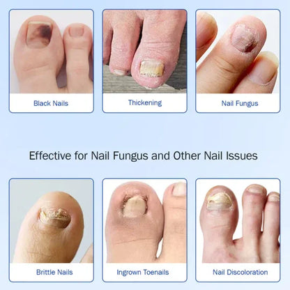 Fungal Nail Patches, 21pcs/box Nail Health Care Patches, Nail Fungus Care Patches, Suitable for Solving Fungal Nails and Other Nail Problems, Nail Supplies, Daily Care Nails Kit Set