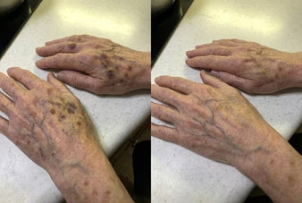 Dermara: Finally, A Cream That Fades Bruises On Fragile Skin