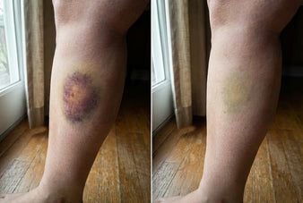 Dermara: Finally, A Cream That Fades Bruises On Fragile Skin