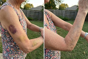 Dermara: Finally, A Cream That Fades Bruises On Fragile Skin