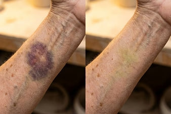 Dermara: Finally, A Cream That Fades Bruises On Fragile Skin